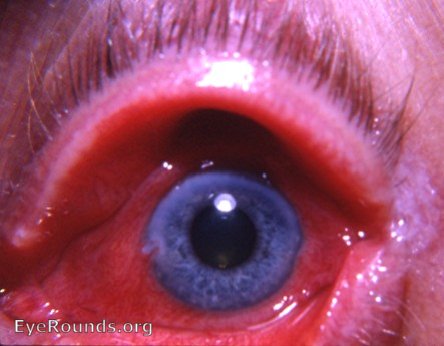 Augengrippe - Keratoconjunctivitis epidemica